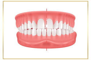 hình ảnh răng cắn chéo