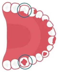 Trường hợp chỉ định trồng răng implant